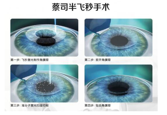 準(zhǔn)分子激光手術(shù)到底是怎么治 愈你的眼睛的？