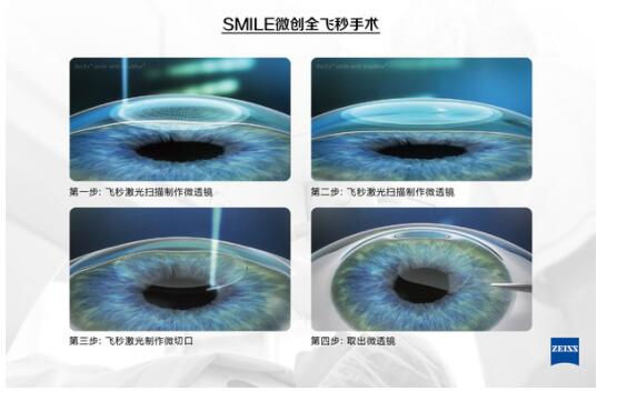 準(zhǔn)分子激光手術(shù)到底是怎么治 愈你的眼睛的？