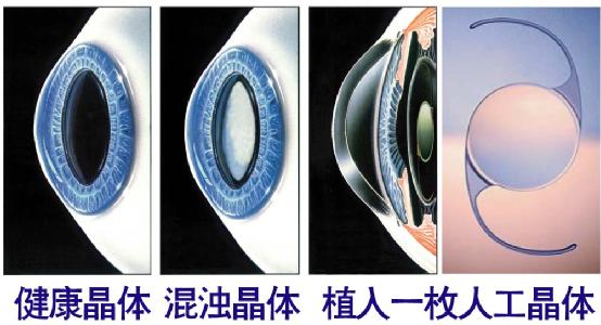 超聲乳化手術(shù)白內(nèi)障危險嗎?