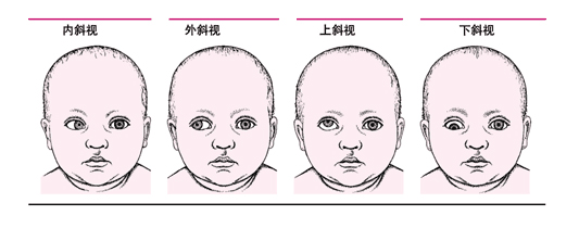 蘭州普瑞眼視光醫(yī)院專(zhuān)家:家長(zhǎng)很粗心孩子有斜弱視都不知道