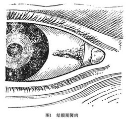 黑眼睛前面多長(zhǎng)出一塊白肉怎么辦？