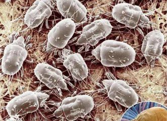 個人衛(wèi)生差，螨蟲會寄宿眼部得蠕形螨瞼緣炎