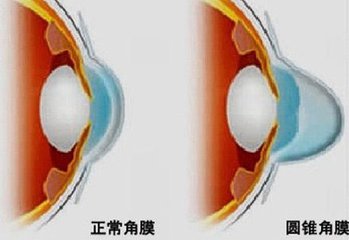 圓錐角膜，哪種角膜移植術(shù)好？