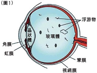 眼睛玻璃體混濁是怎么回事