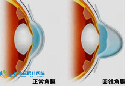 圓錐角膜怎樣？