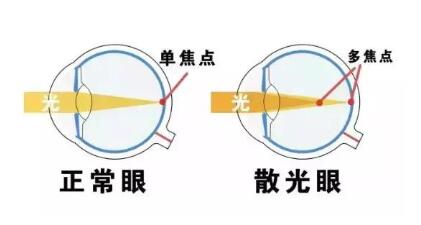 近視和散光，手術(shù)能同時矯正嗎？