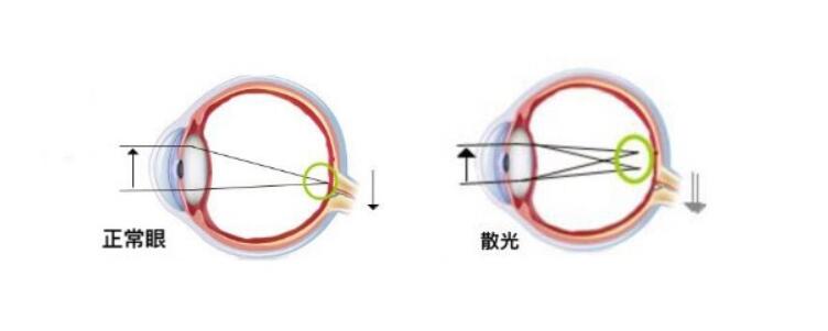 高度散光加近視可以做手術(shù)嗎？