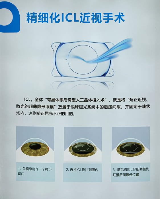 寒假摘鏡總動員，近視朋友的三種矯正近視方式