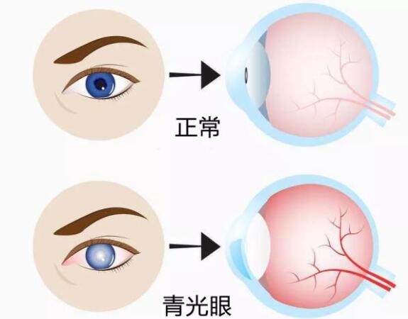第17個青光眼周｜共管慢病青光眼，留得光明恒久遠